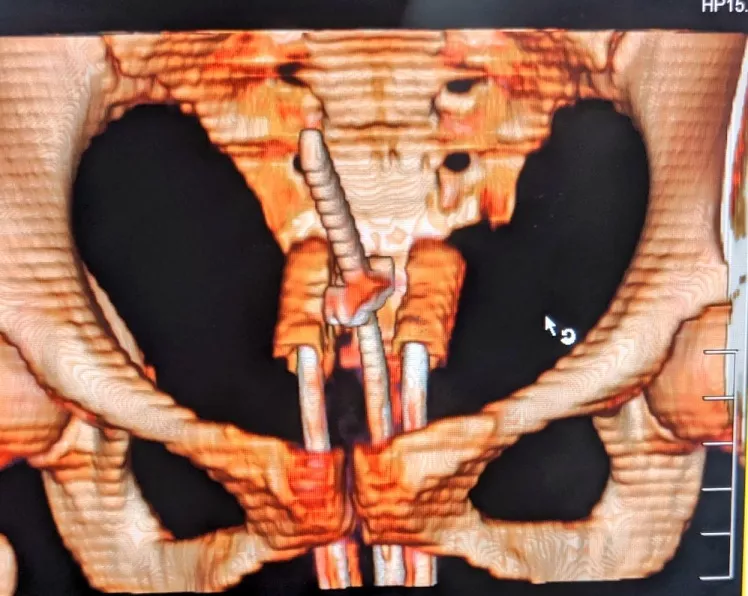 Internal radiation treatment for cervical and womb cancer at KCC Kathmandu