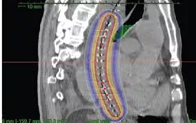 Food pipe cancer treatment — internal radiation restoring the ability to swallow at KCC