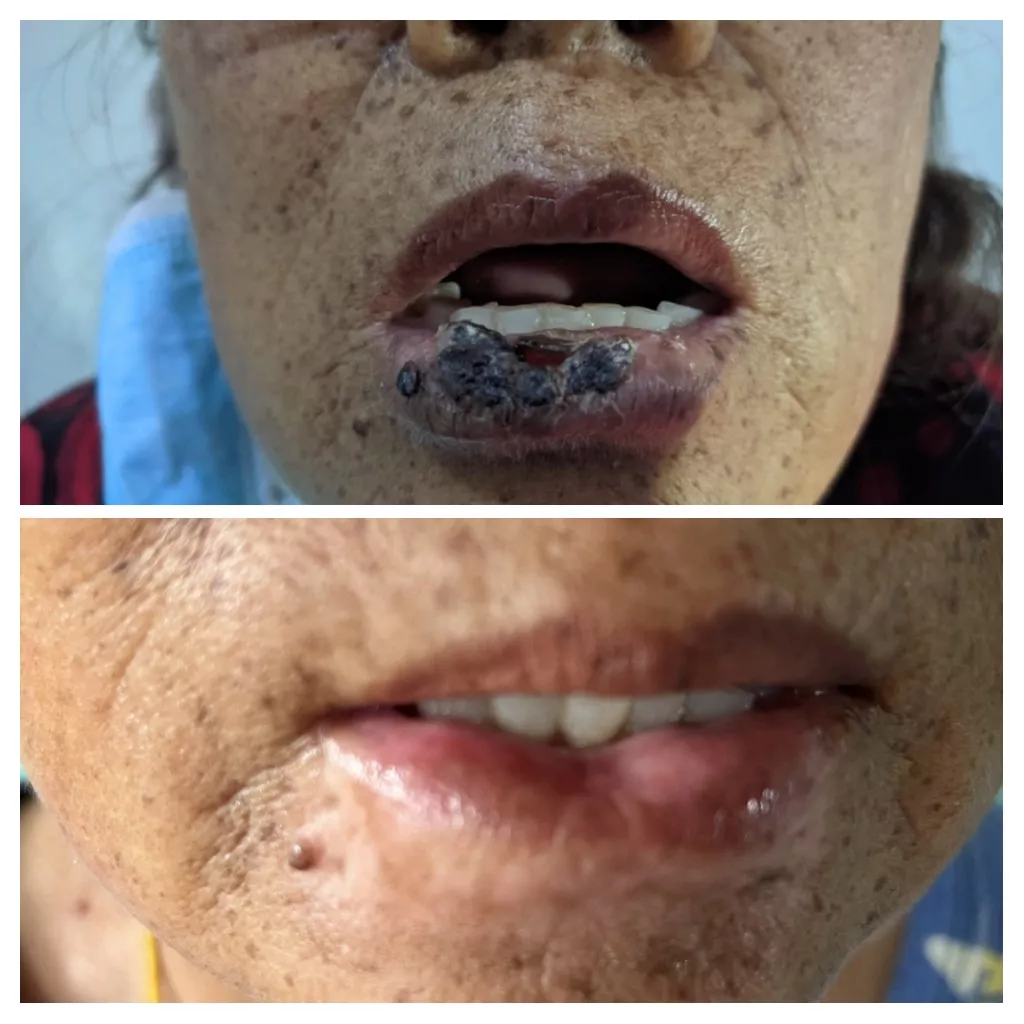 Lip and mouth cancer treated without surgery at KCC — internal radiation, Kathmandu Nepal