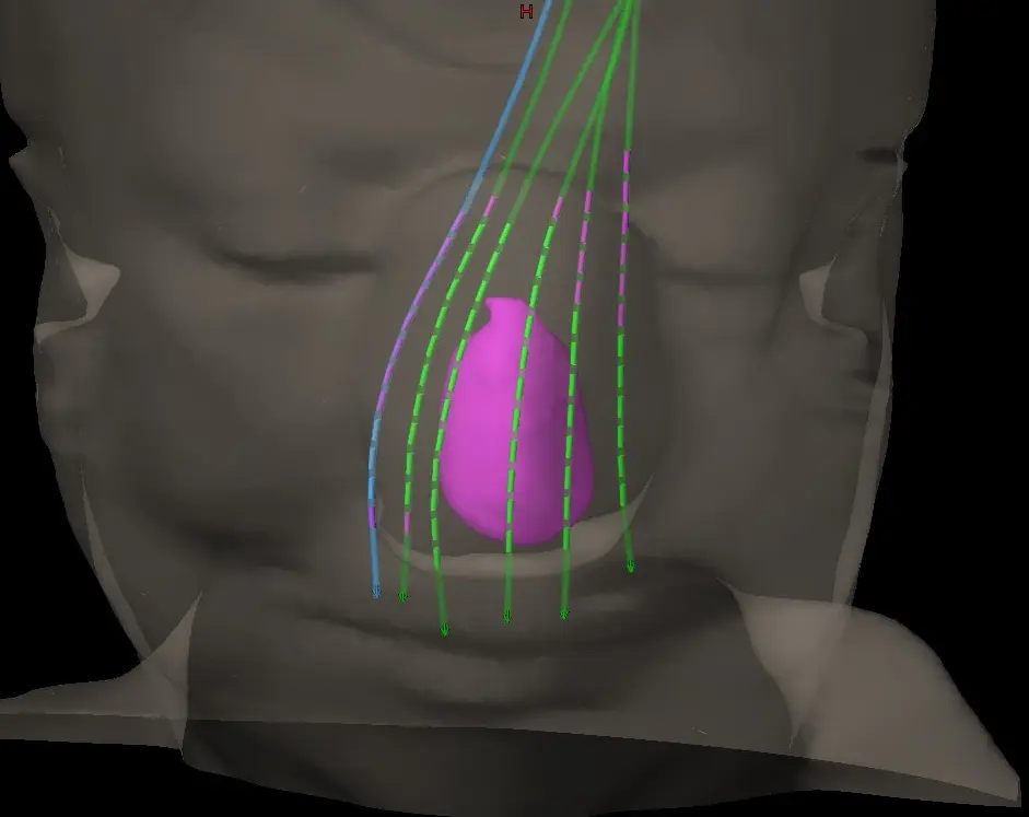 Nasal cavity cancer — internal radiation at KCC Nepal, including re-treatment cases