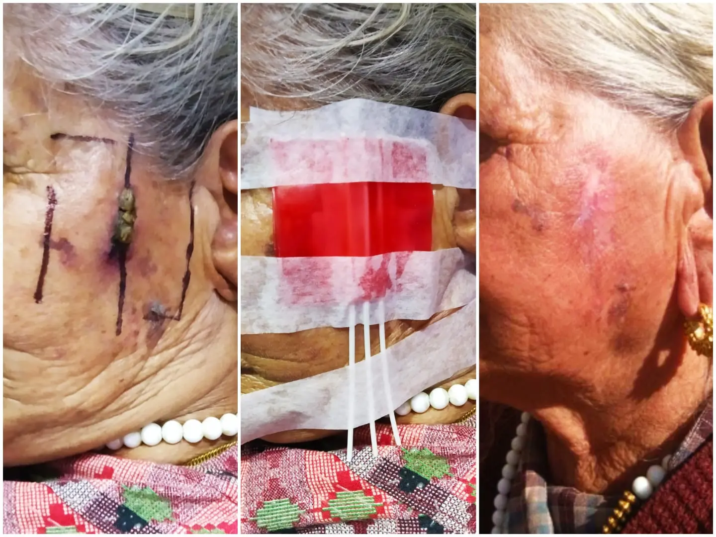 Elderly patient treated for facial skin cancer at KCC — no surgery, no scar, cancer cleared