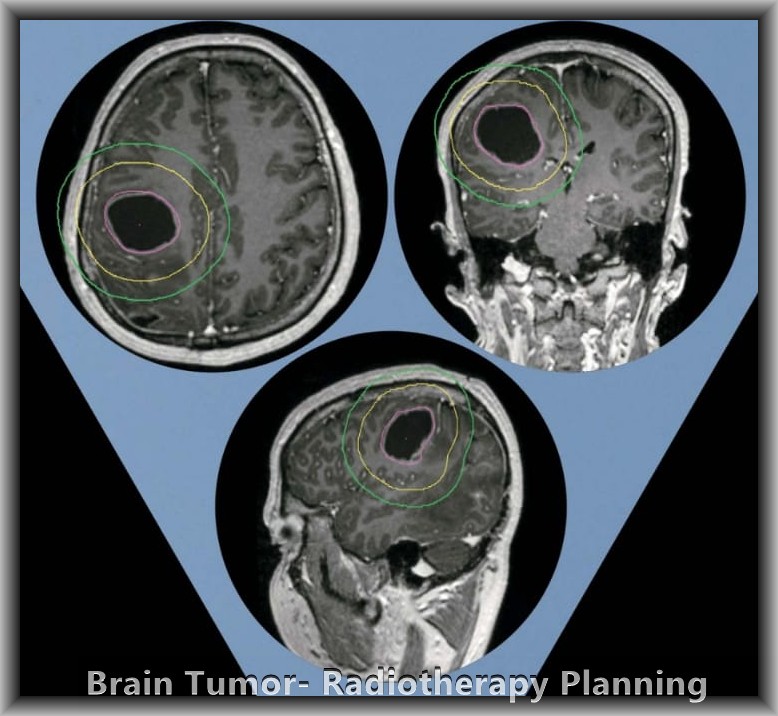 दिमागको ट्युमरको रेडियोथेरापी योजना — VMAT/IMRT CT स्क्यानमा आधारित प्रेसिजन प्लानिङ, KCC काठमाडौं