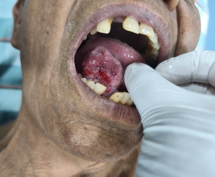 Clinical presentation of a tongue cancer lesion