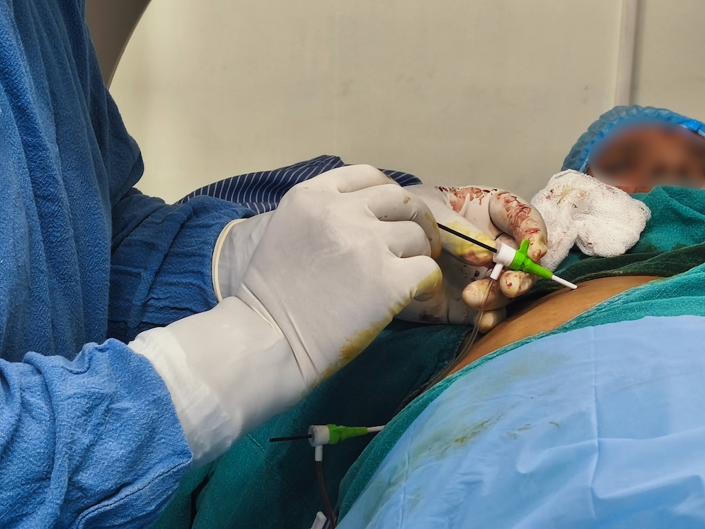 Ablation of a liver tumor by the interventional radiology team