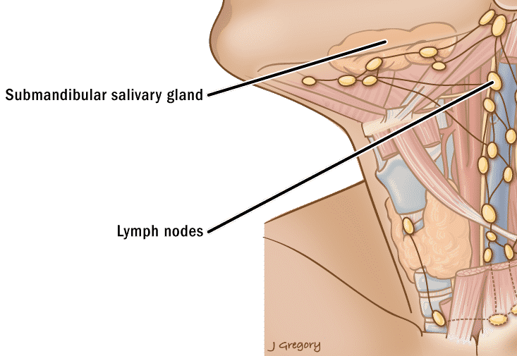 swollen neck node can be cancer