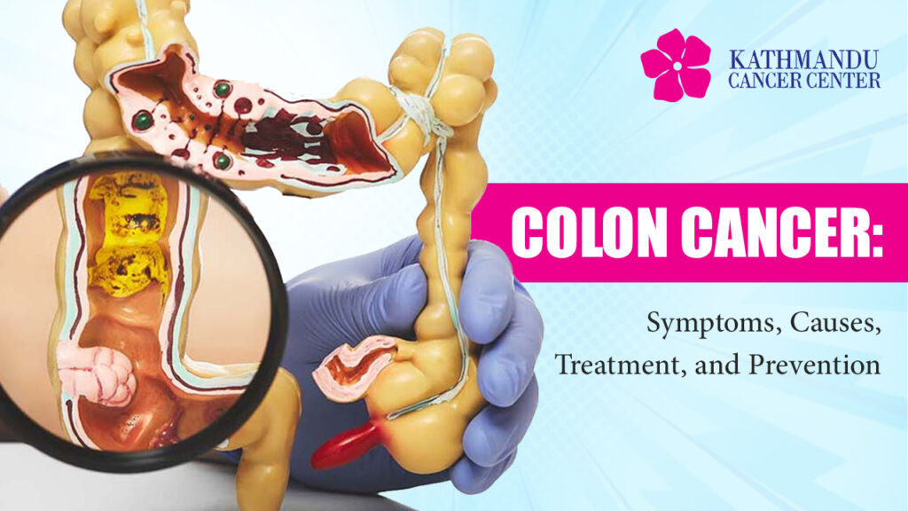 Colon Cancer